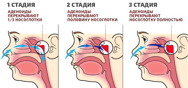 Отит симптомы и лечение