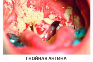tonzillit angina 1