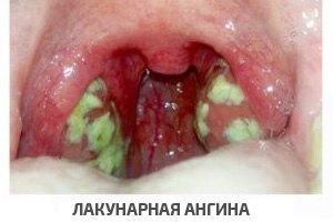 Фото горла взрослого человека при ангине