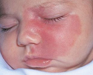 Капиллярная ангиодисплазия кожи лица