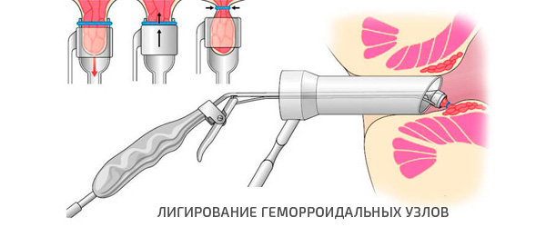 Клиники москвы для лечение геморроя thumbnail