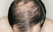 выпадение_волос_лечение