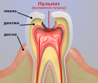 пульпит- стоматология